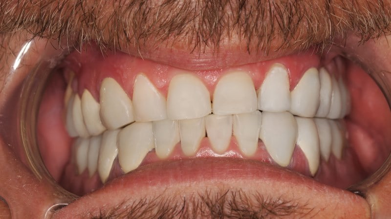 Protezy zębowe Szczecin 5