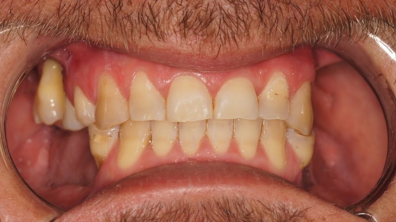 Protezy zębowe Szczecin 6
