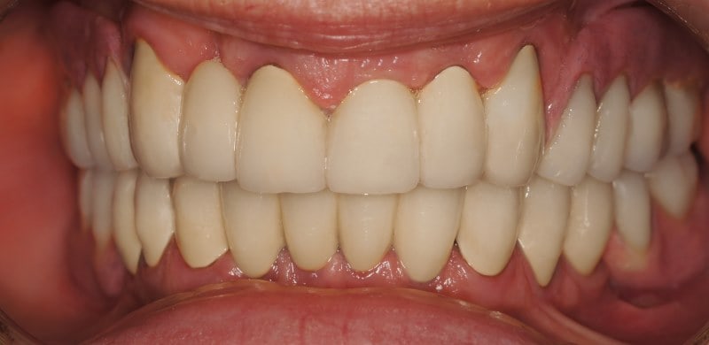 Protezy zębowe Szczecin 7
