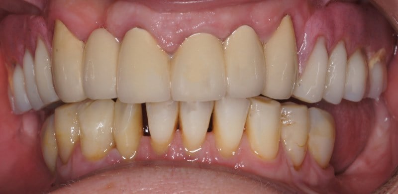 Protezy zębowe Szczecin 8