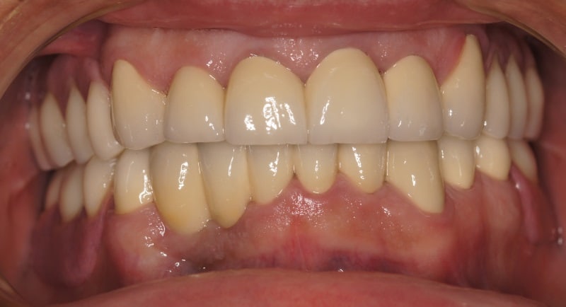 Protezy zębowe Szczecin 3