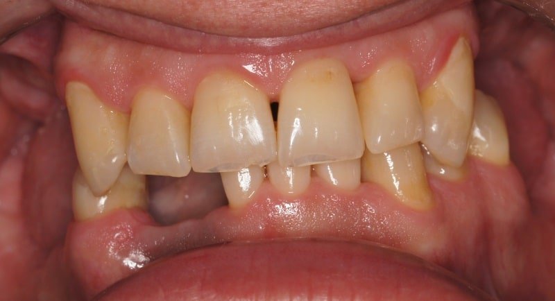 Protezy zębowe Szczecin 4