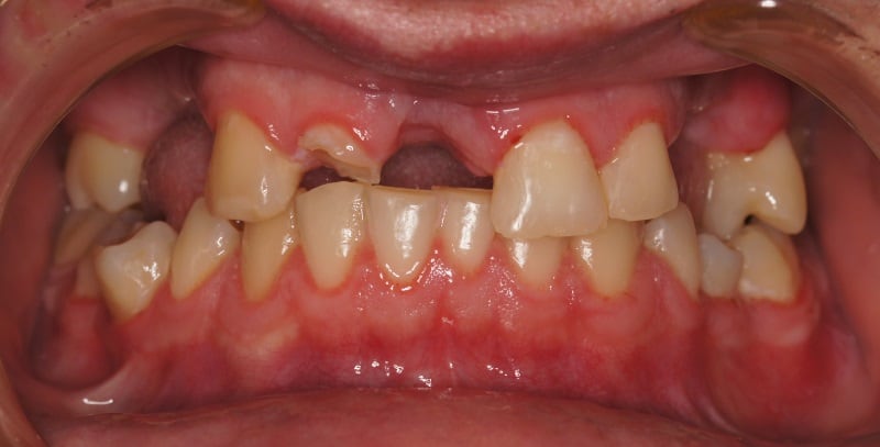 Protezy zębowe Szczecin 2