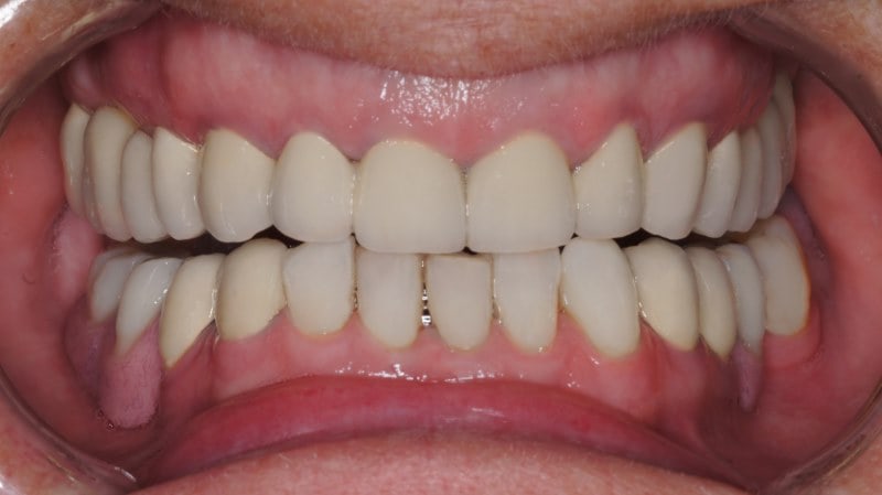 Implanty zębów <span>Szczecin</span> 8