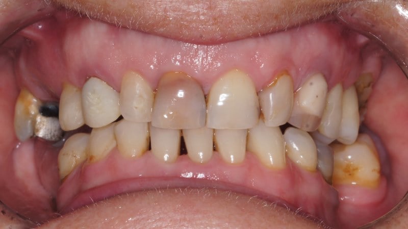 Implanty zębów <span>Szczecin</span> 9