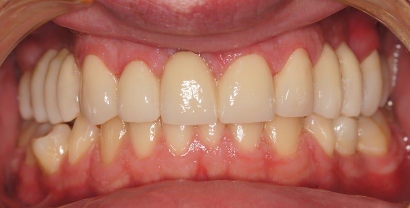 Implanty zębów w Szczecinie 1