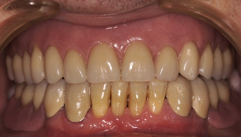 Implanty zębów <span>Szczecin</span> 4