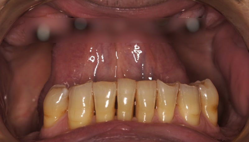 Implanty zębów <span>Szczecin</span> 5